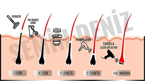 Lazer Epilasyon Pozisyonları: En Etkili Uygulama İçin Yöntemler