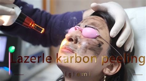 Lazerle Karbon Peeling Yaptıranlar: Deneyimler ve Yorumlar