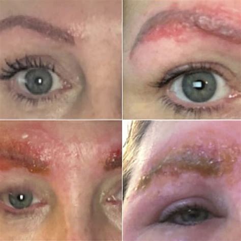 Microblading Allergik Reaksiyonlar